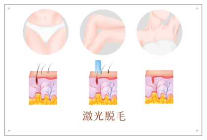 激光脱毛好不好？